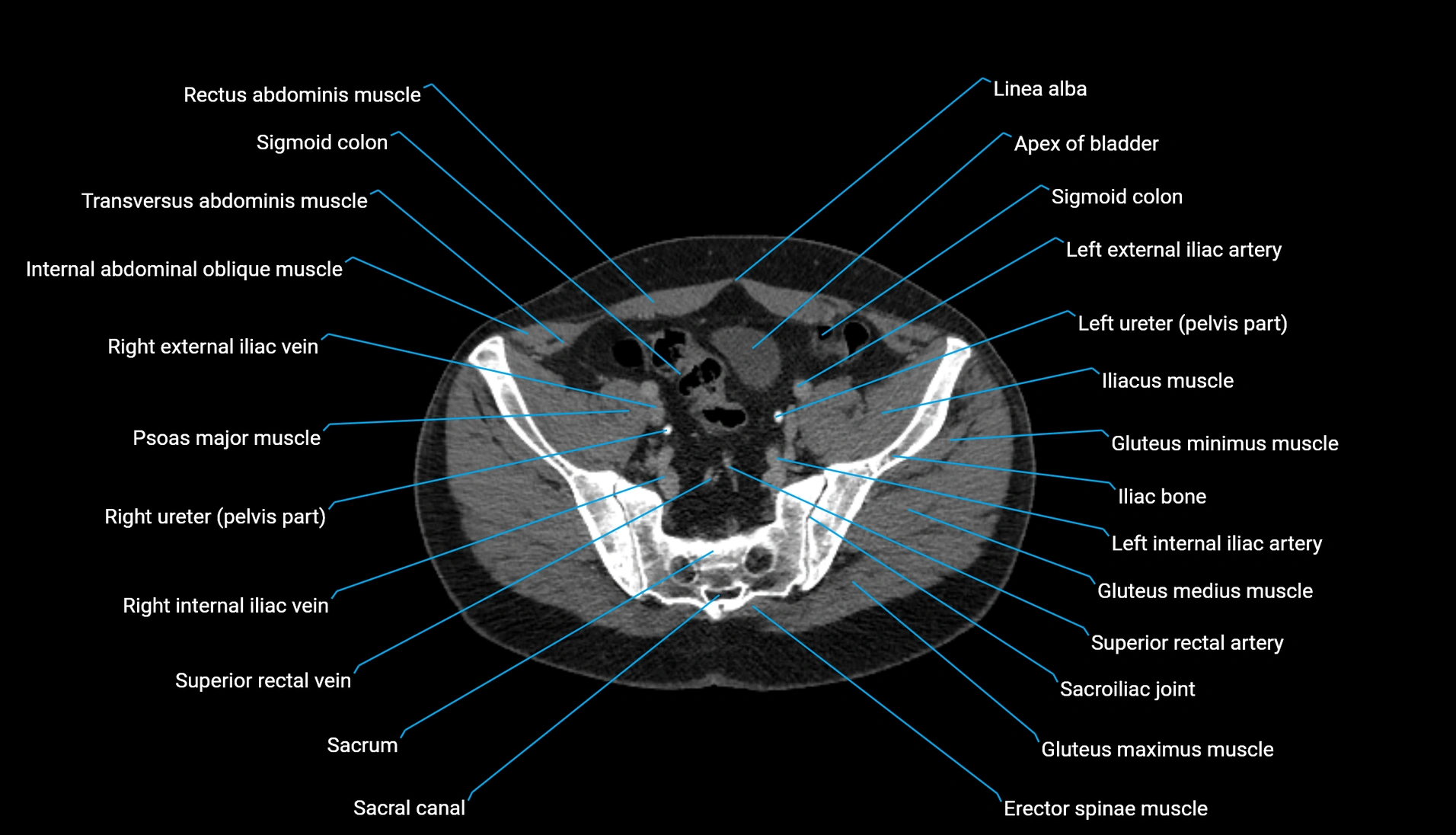 CT urogram axial cross sectional anatomy  labelled radiology image-00195.webp
